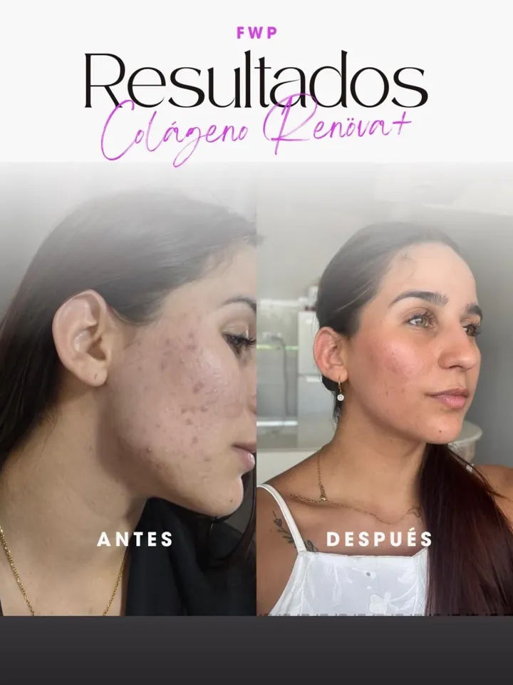 Resultado colágeno — rostro