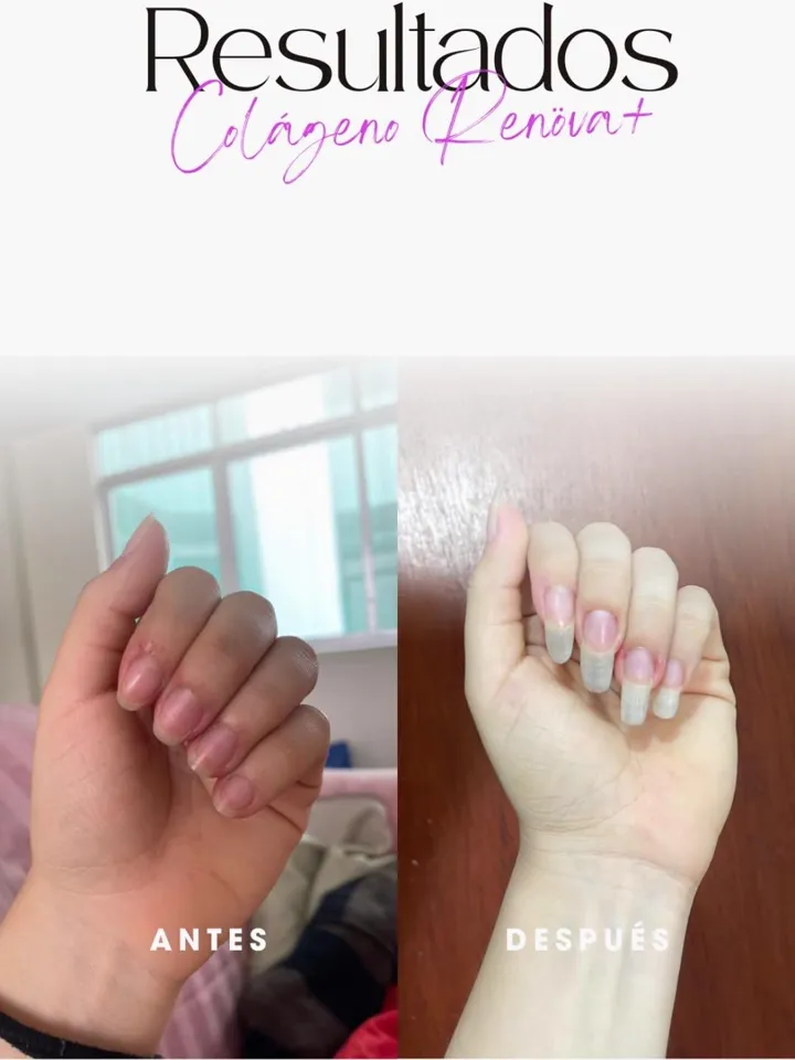Resultado colágeno — uñas
