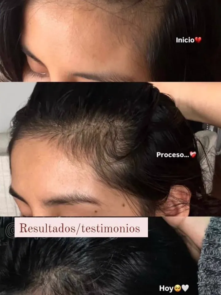 Progreso cabello — inicio, proceso, hoy